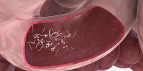 O uso de triplets para eliminar parasitos