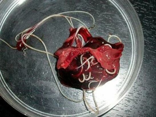 vermes do corpo humano